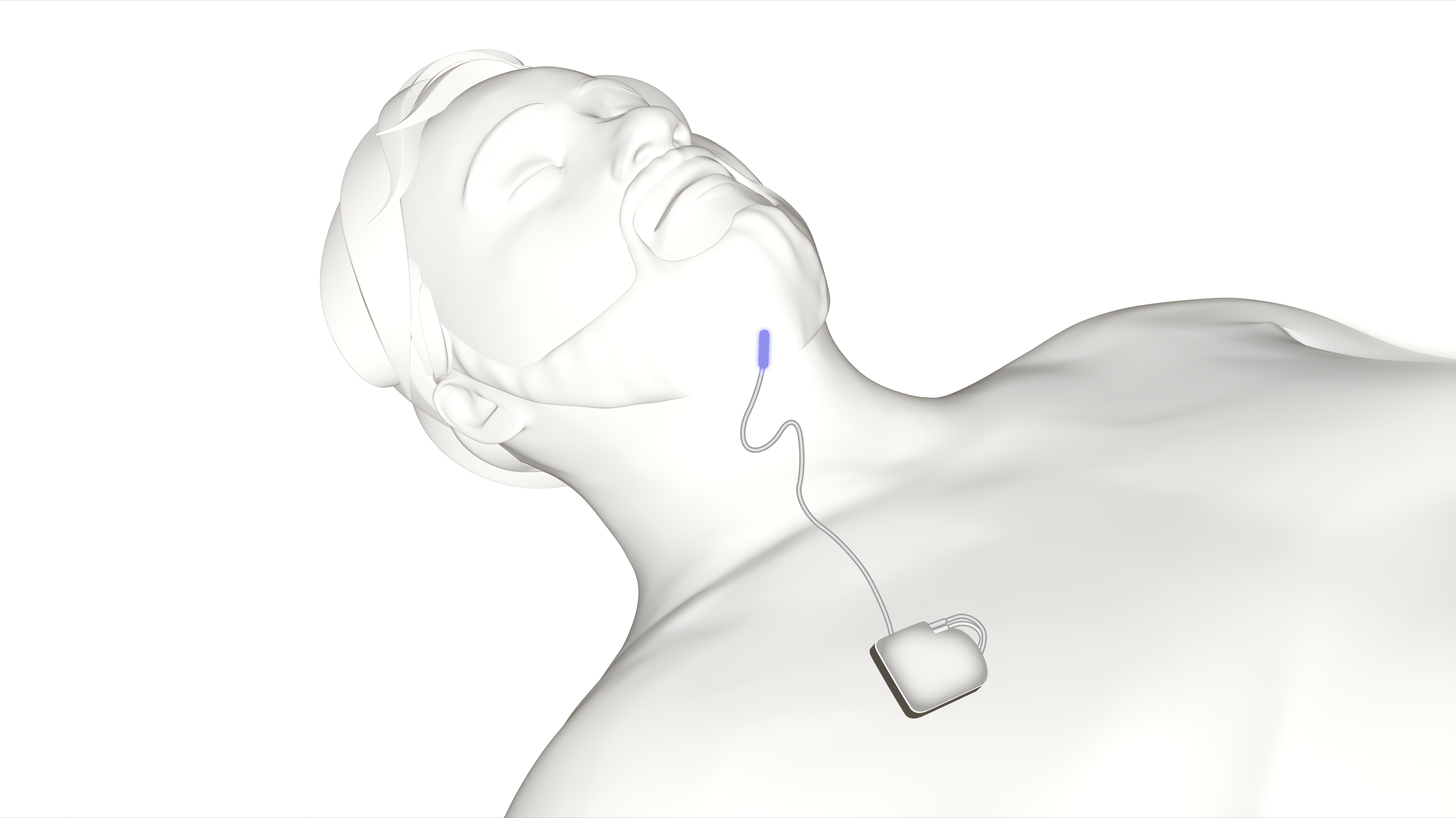 A diagram showing the Inspire Sleep apnea system